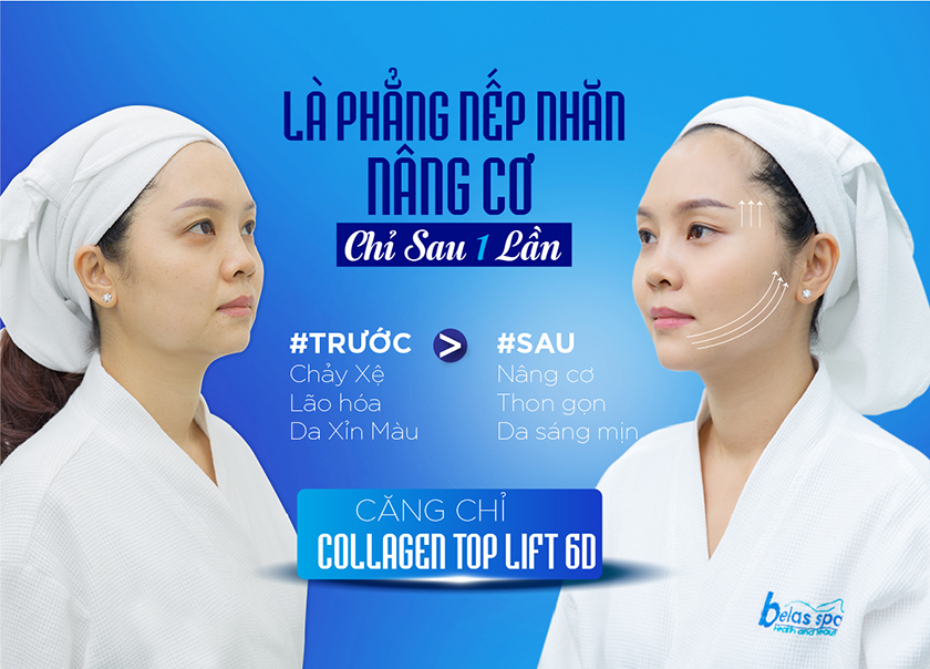 Căng-chỉ-Collagen-tại-Belas