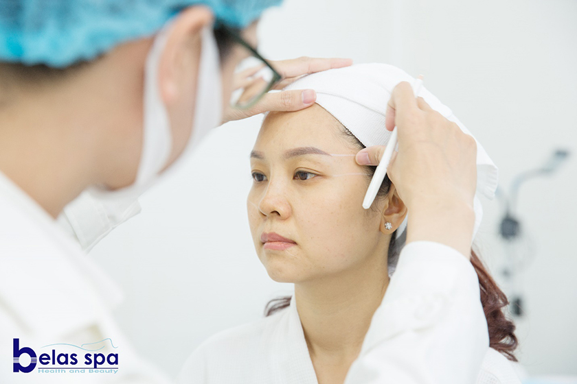 Căng-chỉ-Collagen-tại-Belas