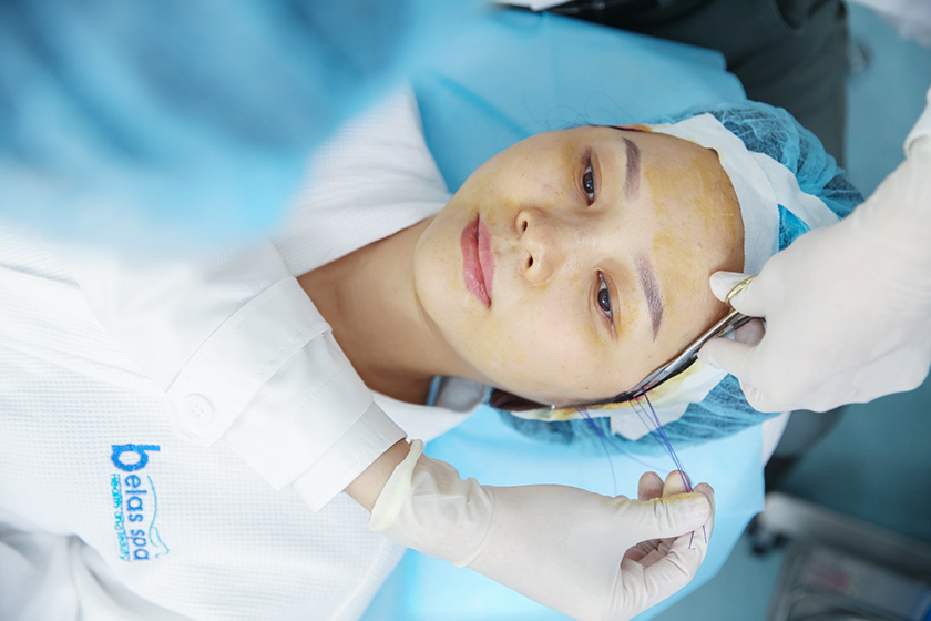 Căng-chỉ-Collagen-tại-Belas